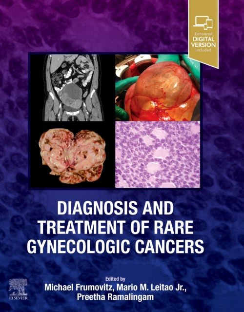 Diagnosis and Treatment of Rare Gynecologic Cancers: Michael, MD, PhD ...